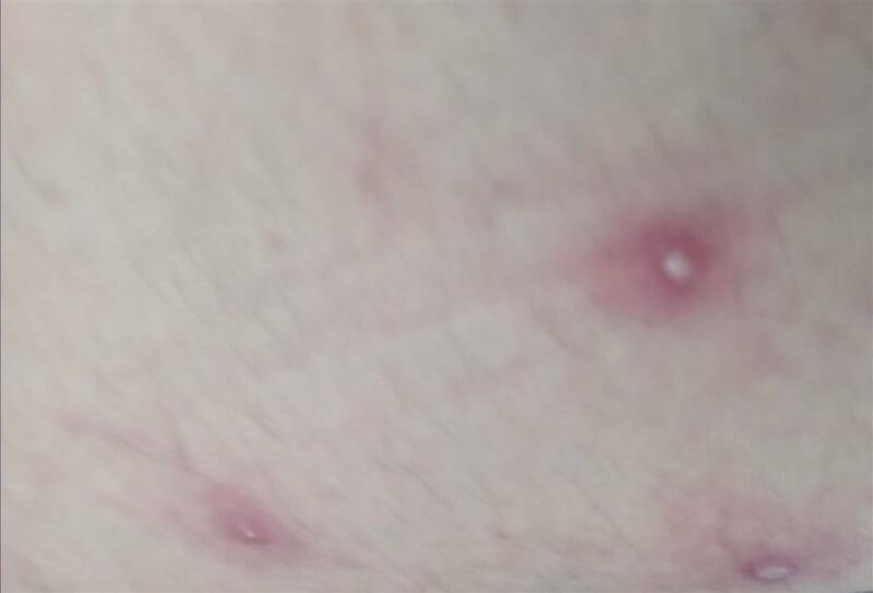 最新确诊病毒，全球的挑战与应对策略