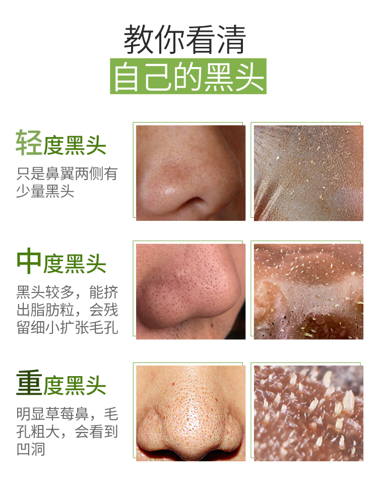 最新去除黑头,实践方案设计_娱乐版19.39.22